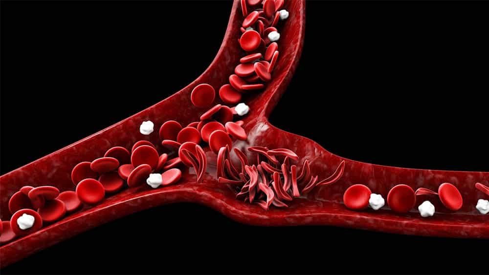 Campanha Junho Laranja alerta para a anemia falciforme e leucemia