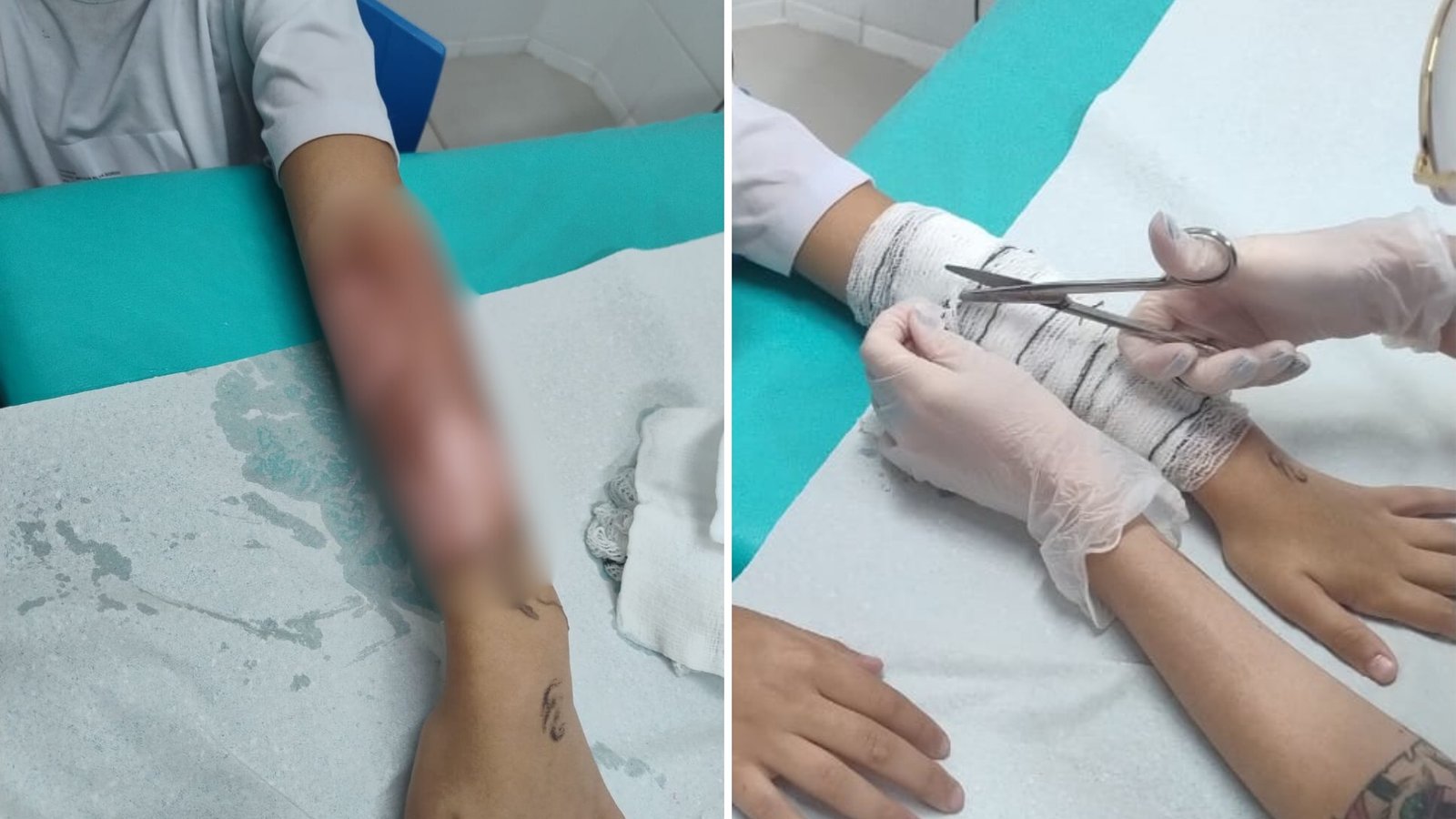 Queimadura Grave: Aluno Ferido em Experimento Escolar com Água Quente