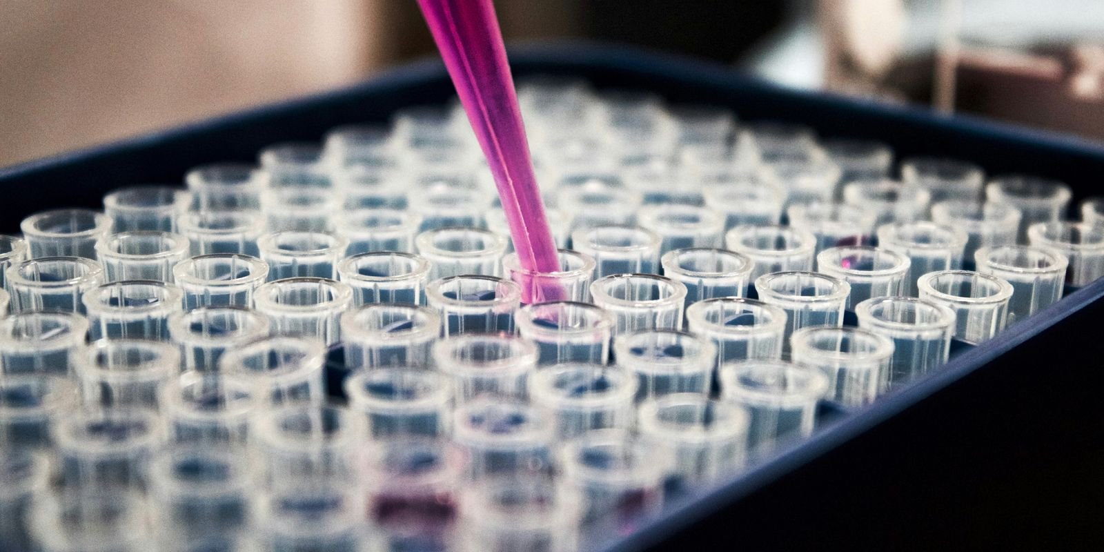 Pesquisas brasileiras avançam no diagnóstico de Alzheimer por exame de sangue