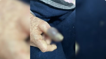 Idosa procura UPA ao notar dedo inchado e escuro e suspeitar de picada de inseto