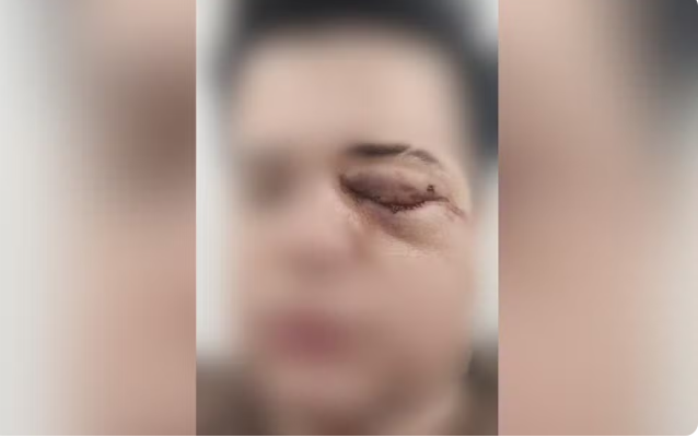 Casal de lésbicas é agredido por homem em restaurante e mulher corre risco de perder visão