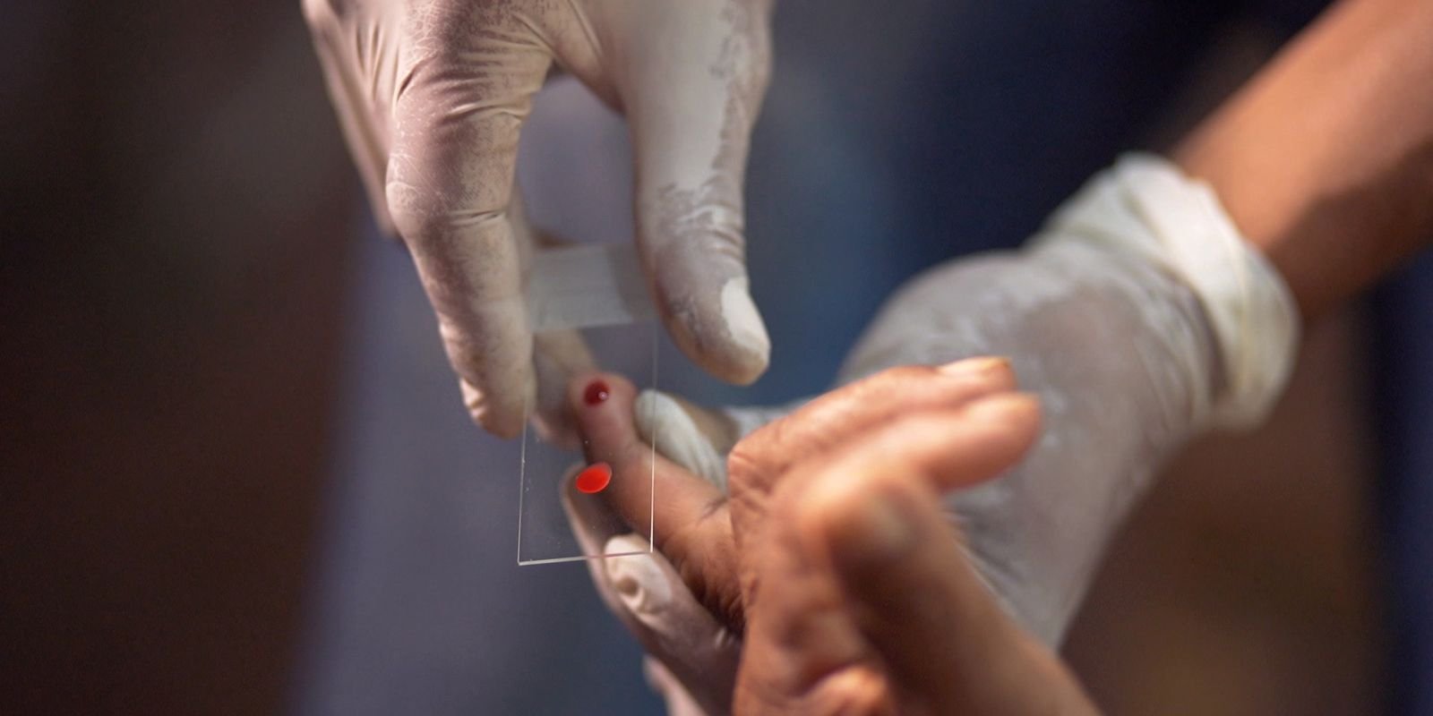 SUS inova com tratamento de dose única contra a malária para crianças