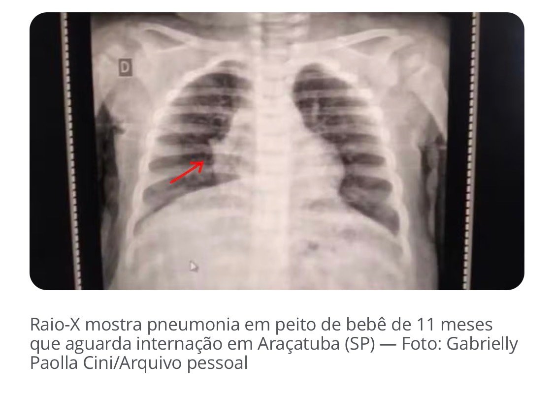 Bebê com pneumonia e dependente de oxigênio nasal espera vaga em hospital há 4 dias em Araçatuba