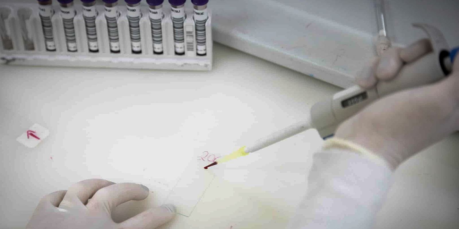 São Paulo em Alerta: Saúde Estadual Investiga Novo Caso Suspeito de Ebola