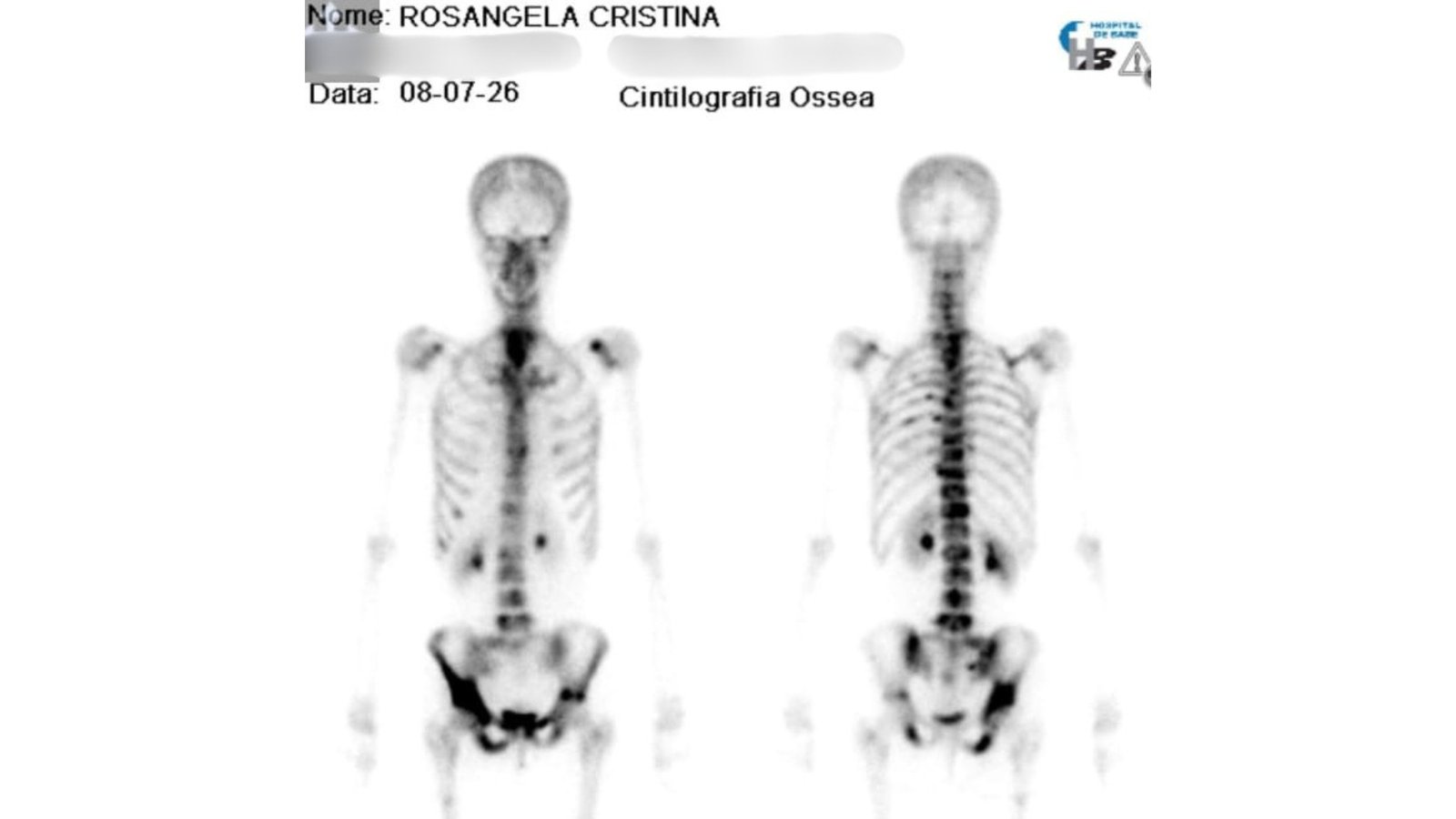 Professora em cuidados paliativos com câncer em quase 100% da coluna e nos ossos decide realizar sonhos: ‘Comecei a viver’
