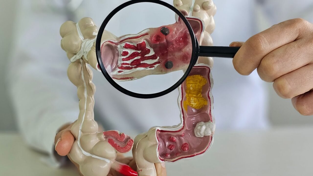 Em 13 anos, doença inflamatória intestinal cresce 5 vezes no Brasil