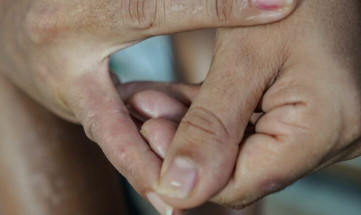 Dermatite atópica impacta pele, sono e autoestima: saiba como tratar