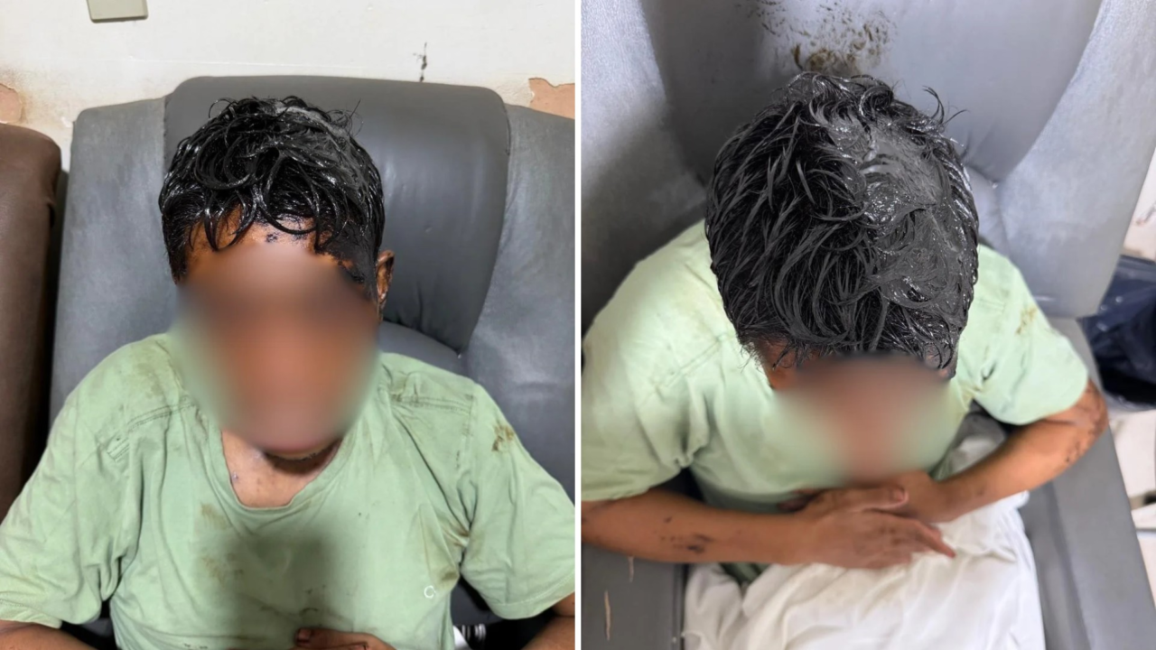 Homem com deficiência intelectual é coberto de óleo diesel queimado e precisa raspar cabelo: ‘Maldade’, diz avó